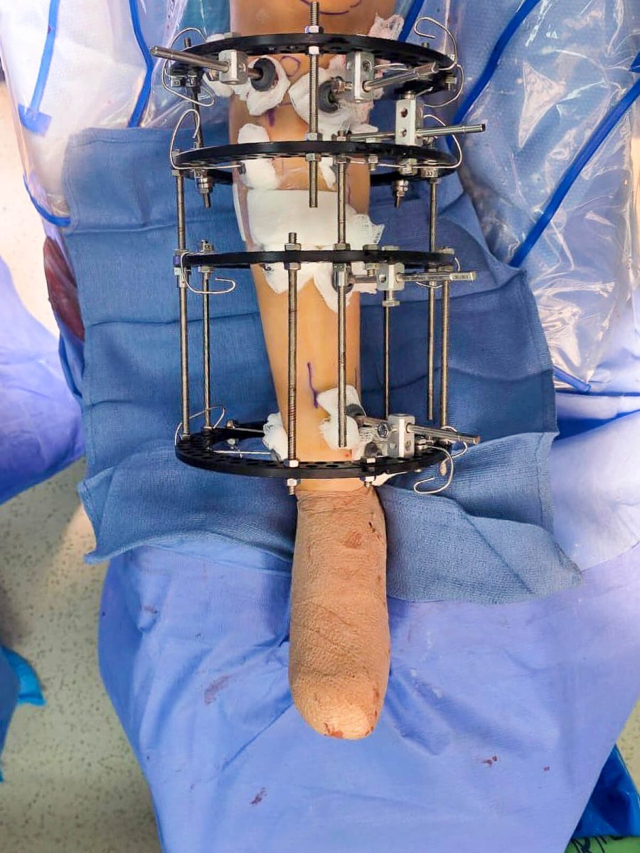 Procedimiento con el método Ilizarov