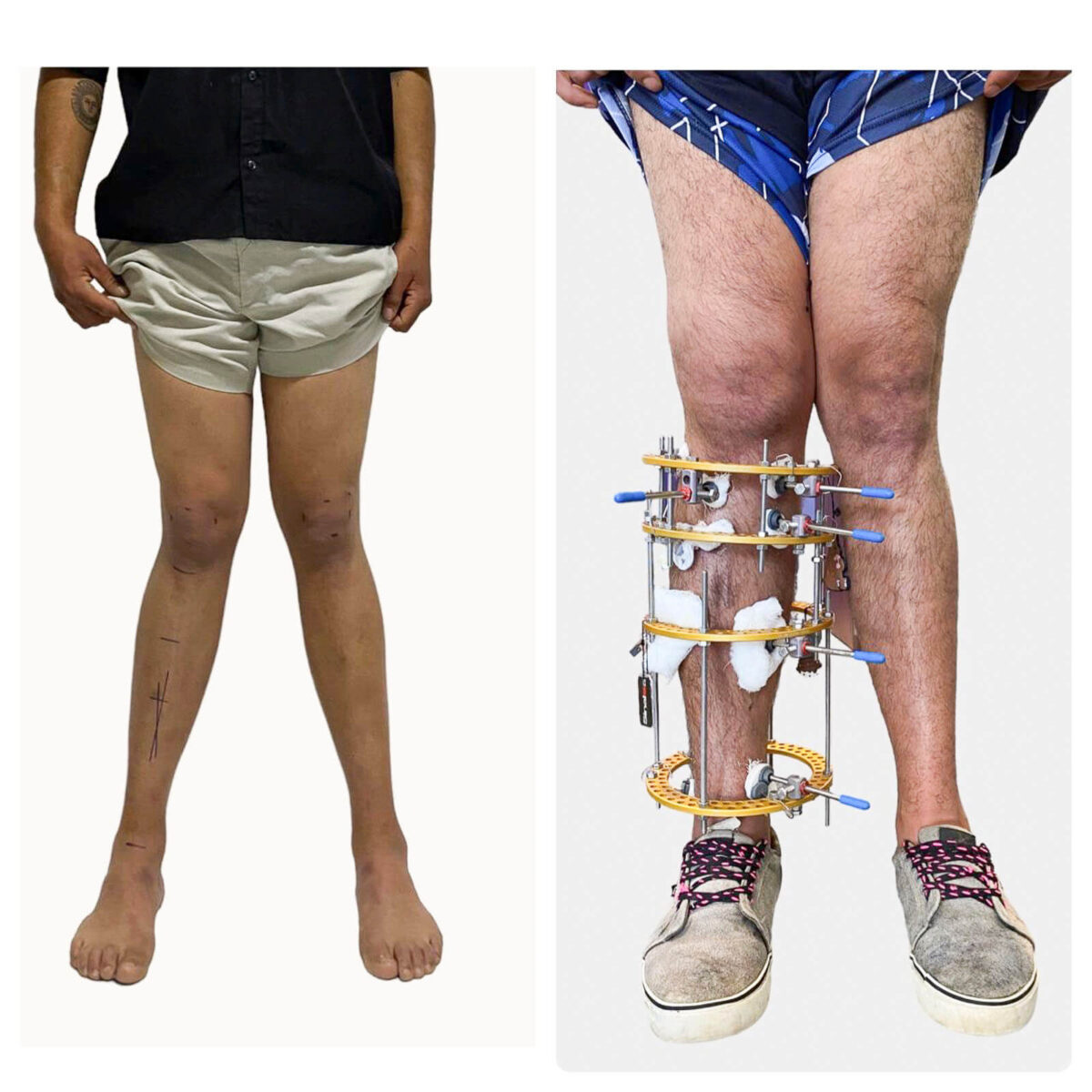 Paciente tratado con el método ilizarov